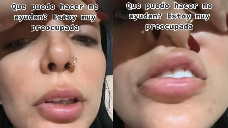 Ashelem mostró los resultados de un tratamiento estético al que se sometió Ashelem mostró los resultados de un tratamiento estético al que se sometió