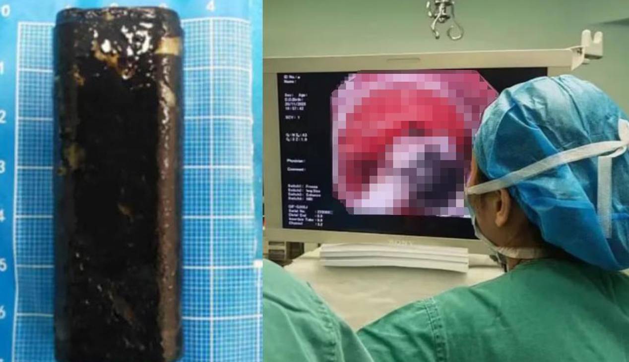 Un hombre sintió dolor abdominal, fue al hospital y le sacaron un encendedor que se tragó hace 34 años