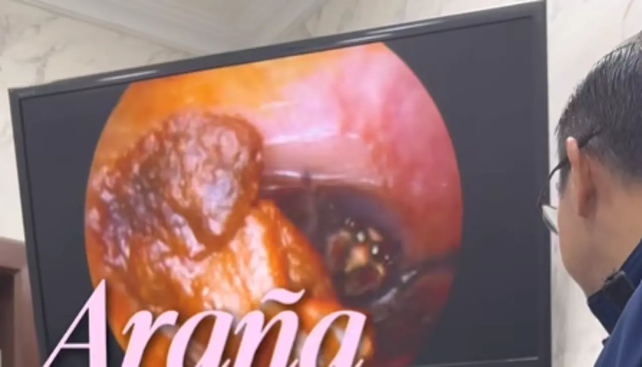 ¡De terror! Una araña se metió al oído de una mujer; así la sacaron 