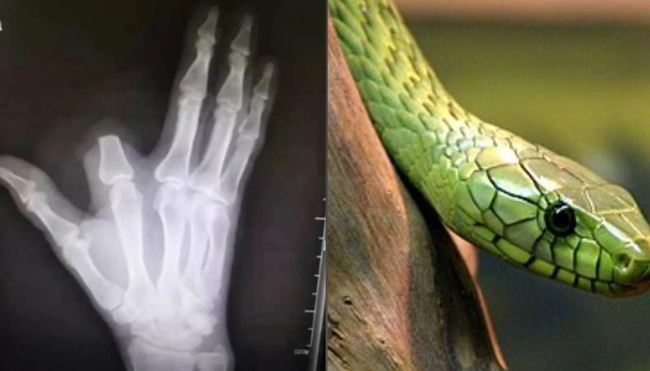 Se cortó el dedo tras ser mordido por una serpiente y los médicos le dijeron que no era venenosa