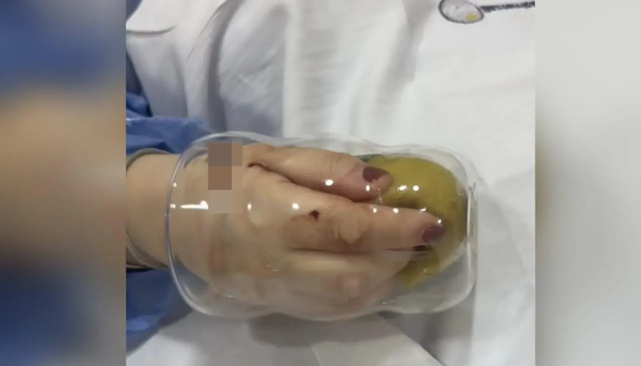 Mujer queda con la mano atrapada en un vaso cuando lavaba y debe ser operada
