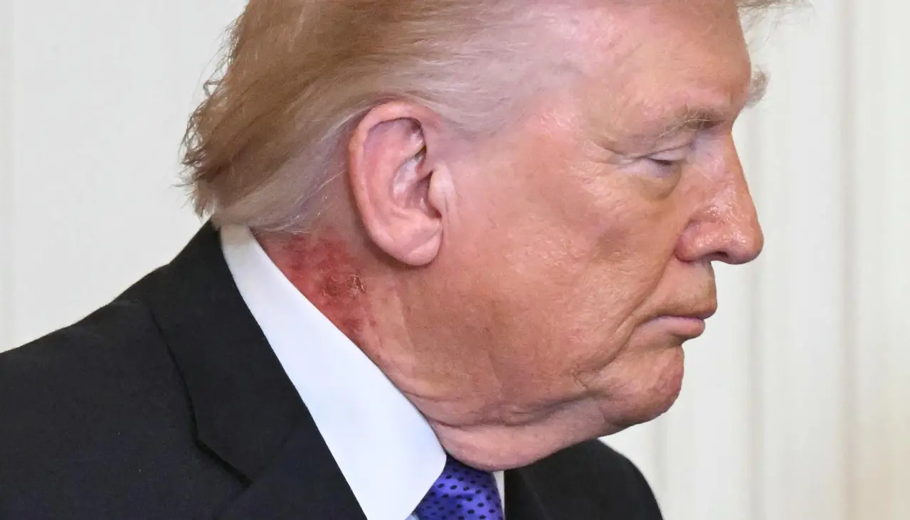 ¿Qué son las marcas rojas en el cuello de Trump? Esto dice el médico del presidente de EEUU