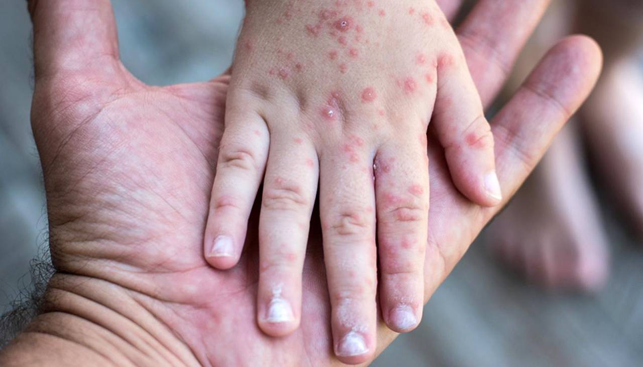 Suben a dos los casos de sarampión en Cochabamba este 2026 tras detección de un contagio en Cercado