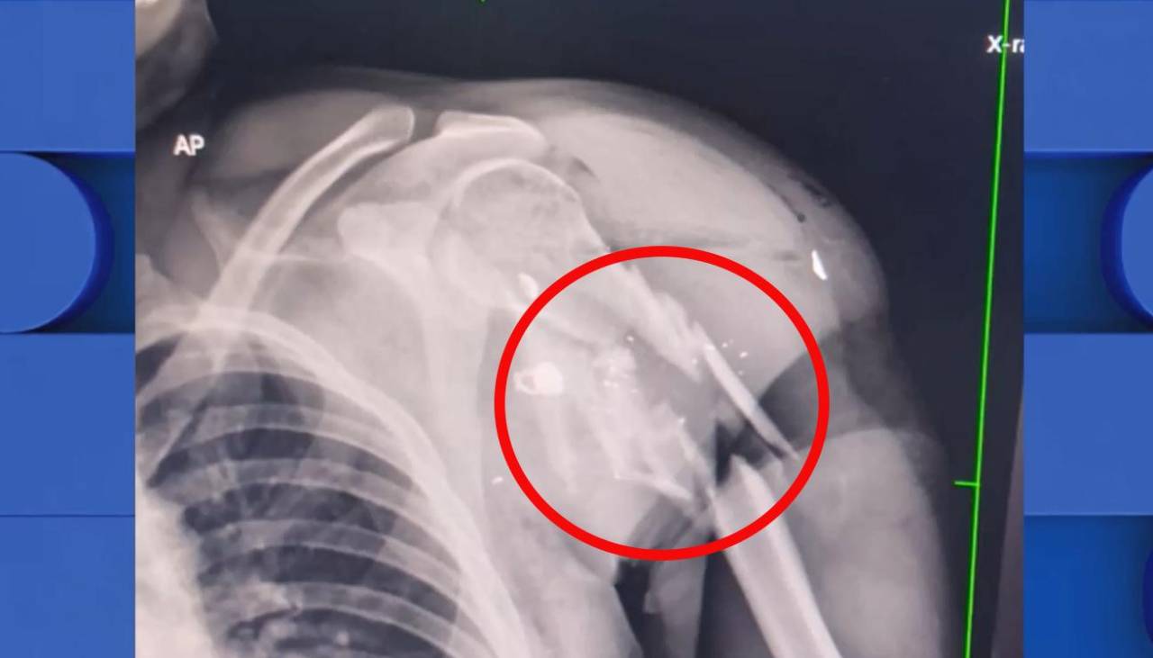 Hombre que fue sacado de una clínica tiene una fractura en el hombro producto de un disparo