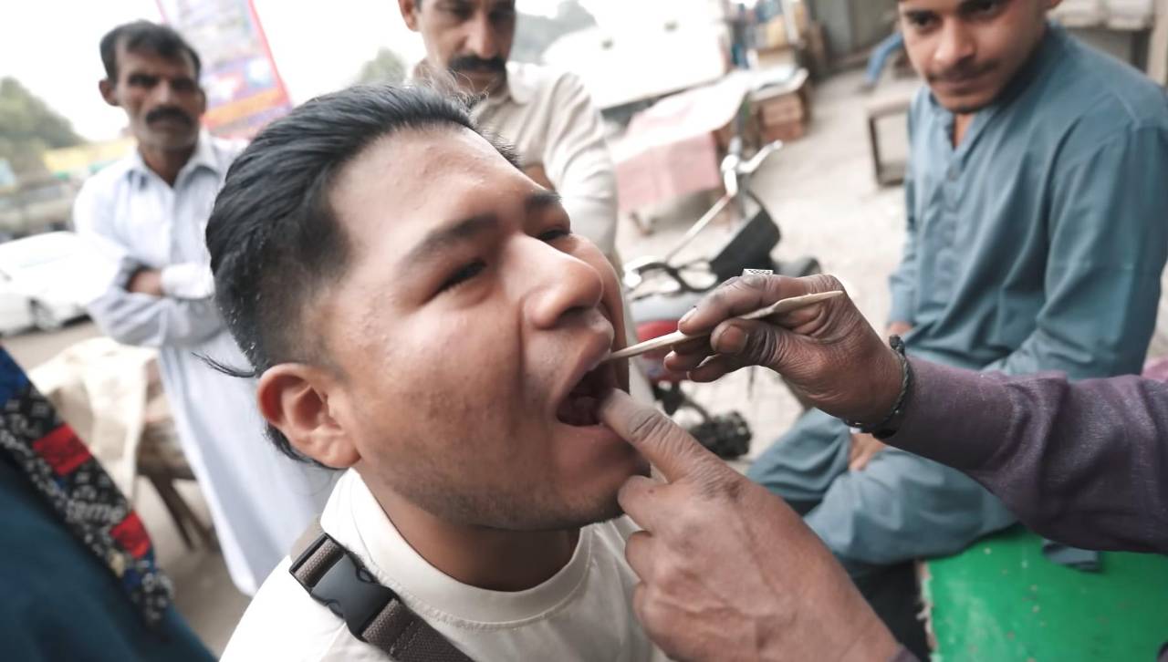 Youtuber boliviano acude a un “dentista callejero” en Pakistán y descubre que le pusieron material cancerígeno