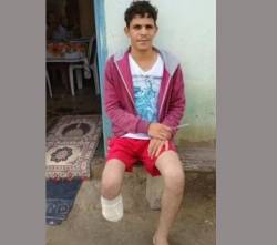 Se amputó un pie para recibir  una ‘millonaria indemnización’ del seguro, pero fue condenado por la Justicia