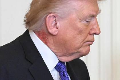 ¿Qué son las marcas rojas en el cuello de Trump? Esto dice el médico del presidente de EEUU