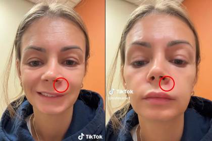 Una joven termina hospitalizada tras reventarse un grano en el ‘triangulo de la muerte’