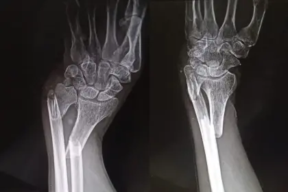 Denuncian que un cacique en la Chiquitania fue golpeado hasta fracturarle los brazos y sospechan de avasalladores