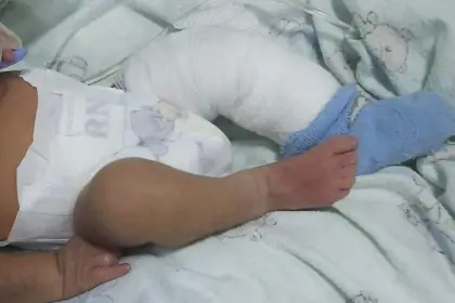 Bebé con quemaduras en hospital: Fiscalía investiga y pide lista del personal que lo atendió