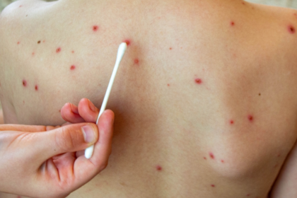 Falta de planificación propicia brotes de enfermedades como el sarampión y la coqueluche, dice epidemiólogo