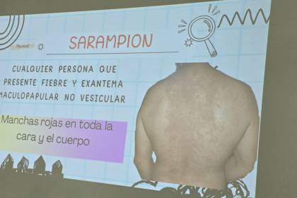 Suben a 14 los casos de sarampión en Santa Cruz; seis hermanos no vacunados, son los últimos afectados