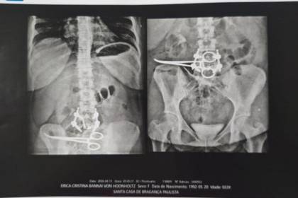 Paciente dice que le dejaron dentro de su cuerpo una pinza tras someterse a una cirugía 