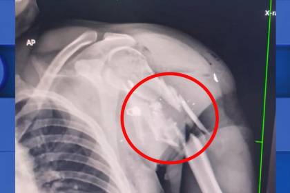 Hombre que fue sacado de una clínica tiene una fractura en el hombro producto de un disparo