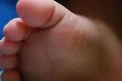 Beni reporta su primer caso de sarampión, se trata de una niña procedente en Santa Cruz