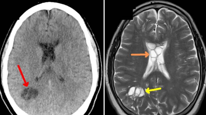 Una tomografía muestra el parásito en el cerebro del sujeto 