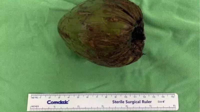 El coco que los doctores extrajeron a un paciente