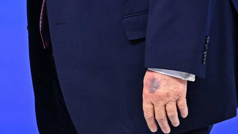 Un moretón es visible en el dorso de la mano izquierda del presidente estadounidense Donald Trump.
