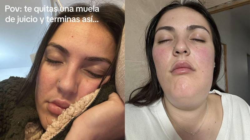 El rostro inflamado de una joven que se hizo extraer la muela del juicio