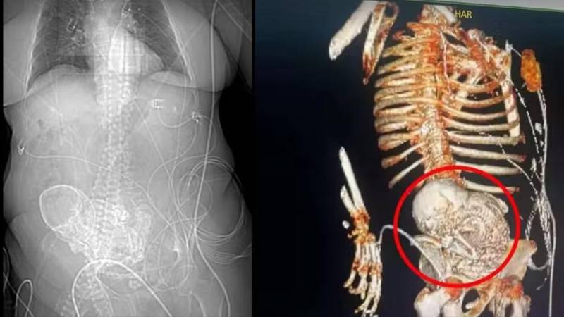 Tomografía del bebé de piedra en el vientre de la mujer