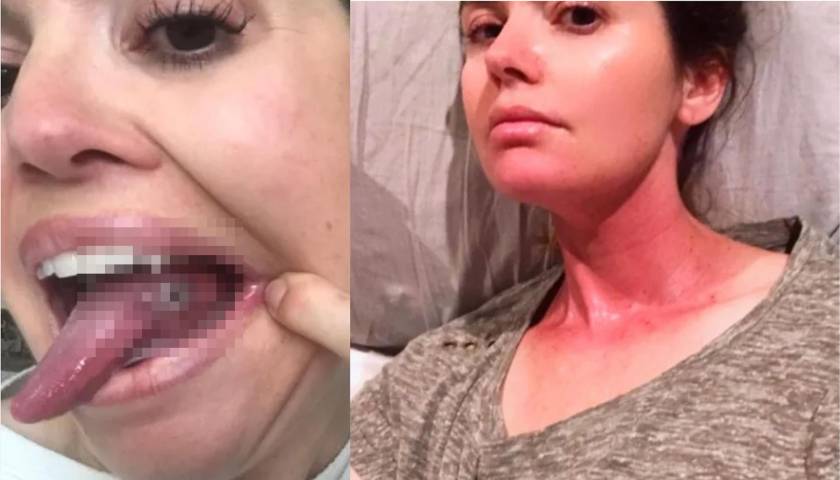 El caso de una mujer que pensó que se mordió la lengua mientras dormía, pero lo que descubrió fue algo peor