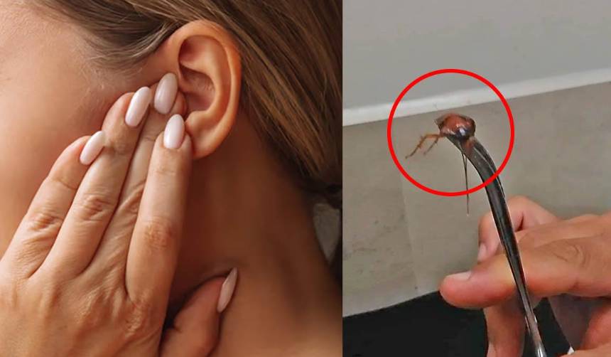 Video: Sentía molestias cerca del tímpano y le encontraron un chulupi habitando en el oído