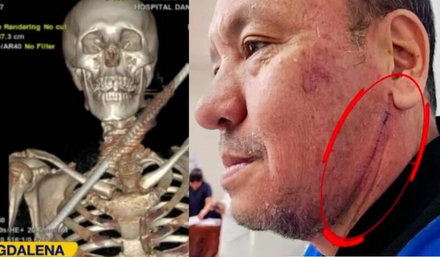 “Estuve muerto 50 segundos”: Un fierro le atravesó el cuello a un hombre tras jugar fútbol y vive para contarlo
