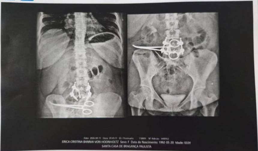 Paciente dice que le dejaron dentro de su cuerpo una pinza tras someterse a una cirugía 