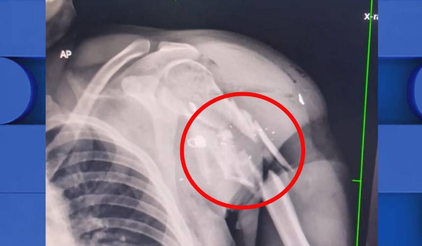 Hombre que fue sacado de una clínica tiene una fractura en el hombro producto de un disparo