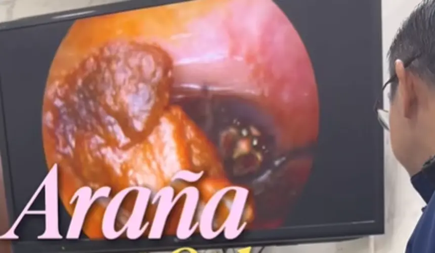 ¡De terror! Una araña se metió al oído de una mujer; así la sacaron 